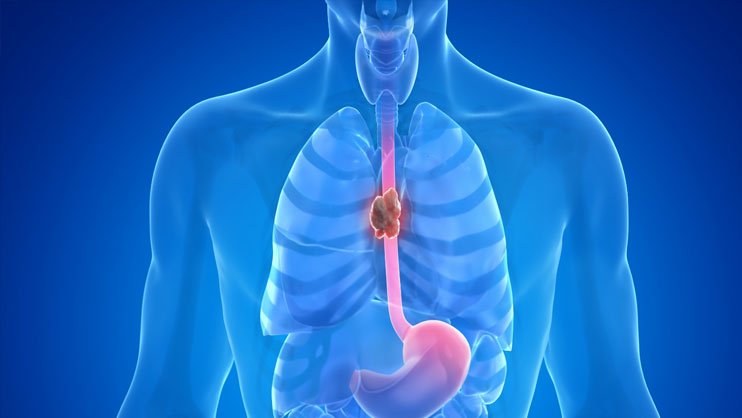 specialist for esophagus cancer in gurgaon