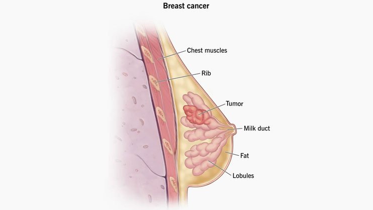 breast cancer specialist in gurgaon