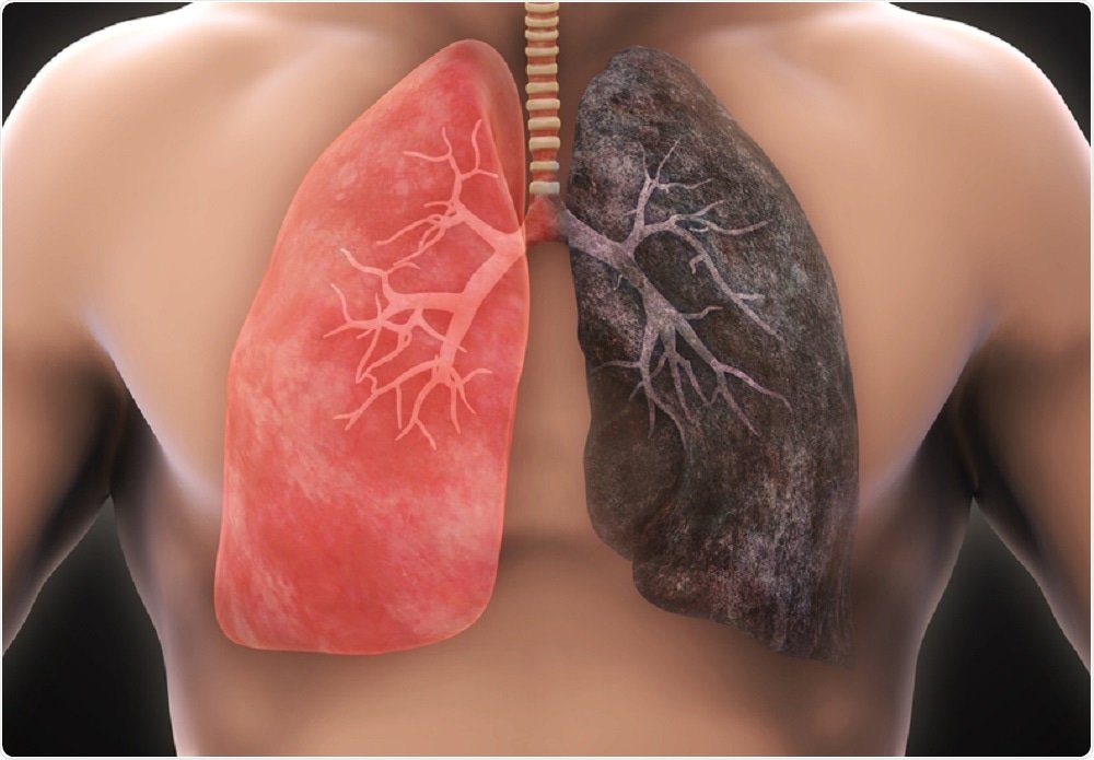 treatment for lung cancer in gurguram